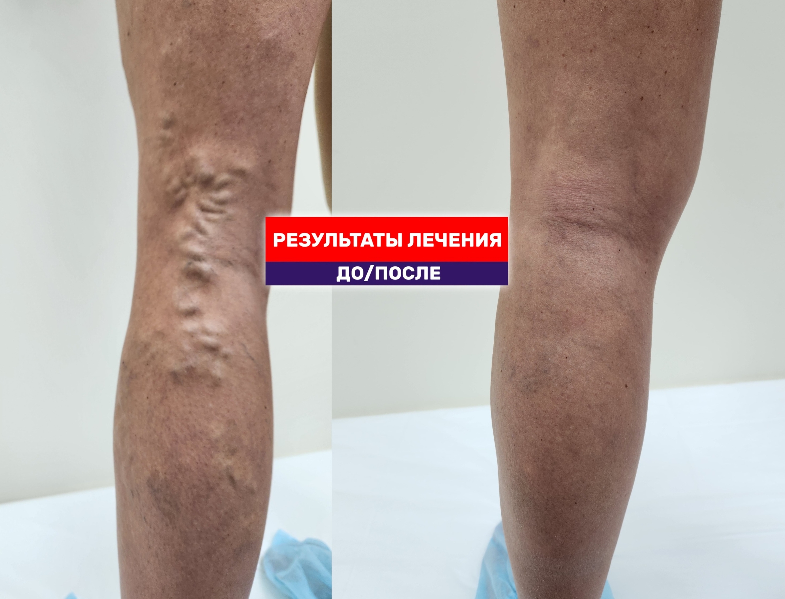 Когда никто не верит, что была операция. Результат Тотал ЭВЛК через 2 года