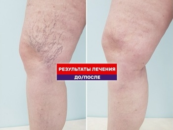 Год после склеротерапии! Честный видео разбор в рубрике "ДО/ПОСЛЕ"