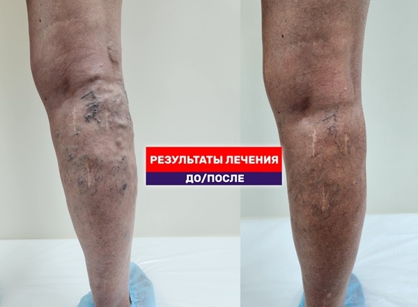 Исправляем ошибки прошлых вмешательств: результат тотальной ЭВЛК