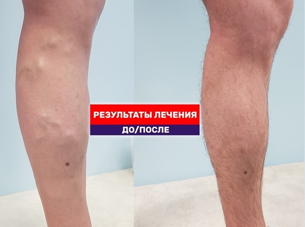 У пациента в 35 лет уже выраженный варикоз! И какая чистая нога после лечения лазером
