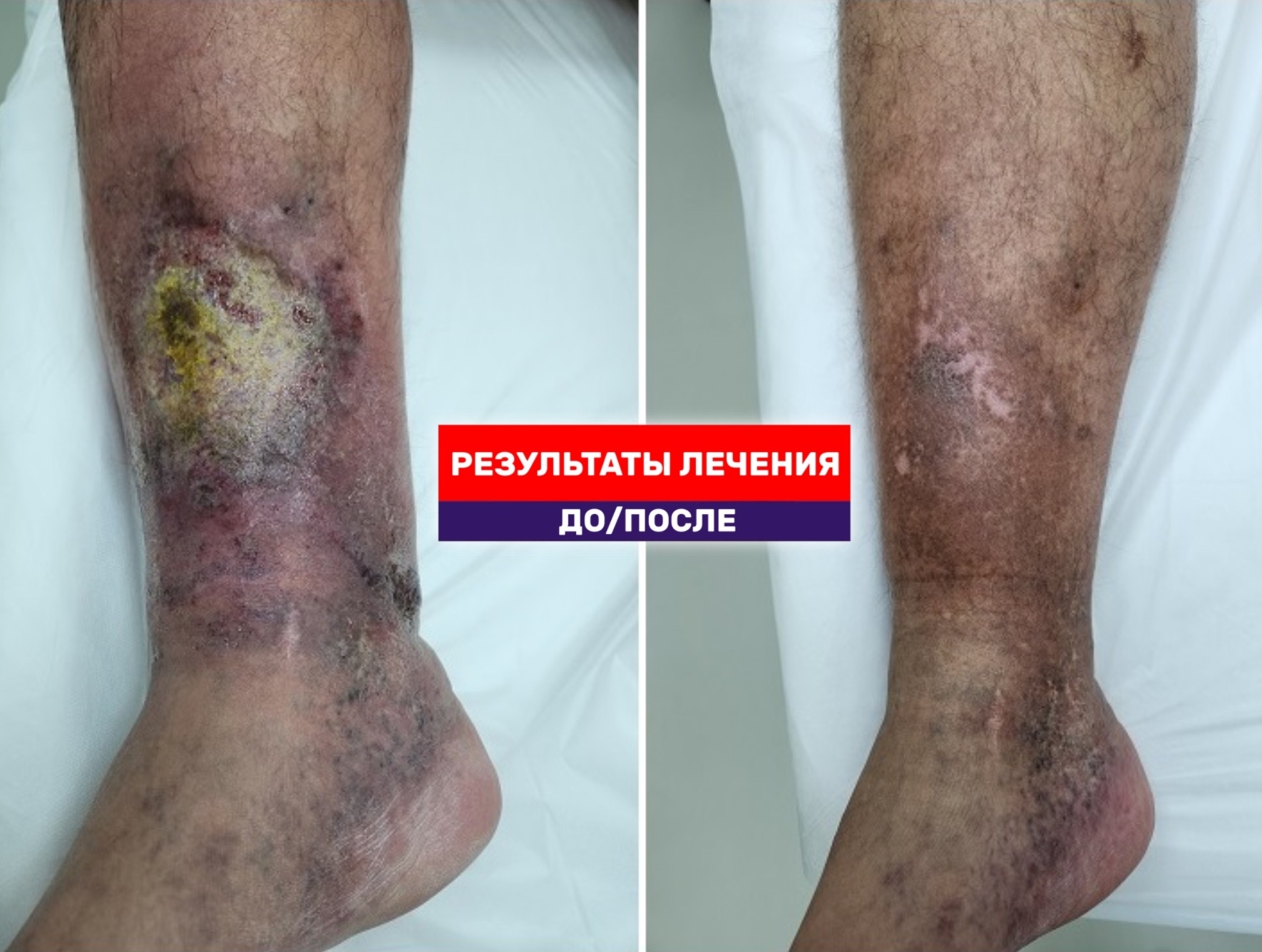 Пациент из Казахстана в восторге — язва затянулась за 3 месяца