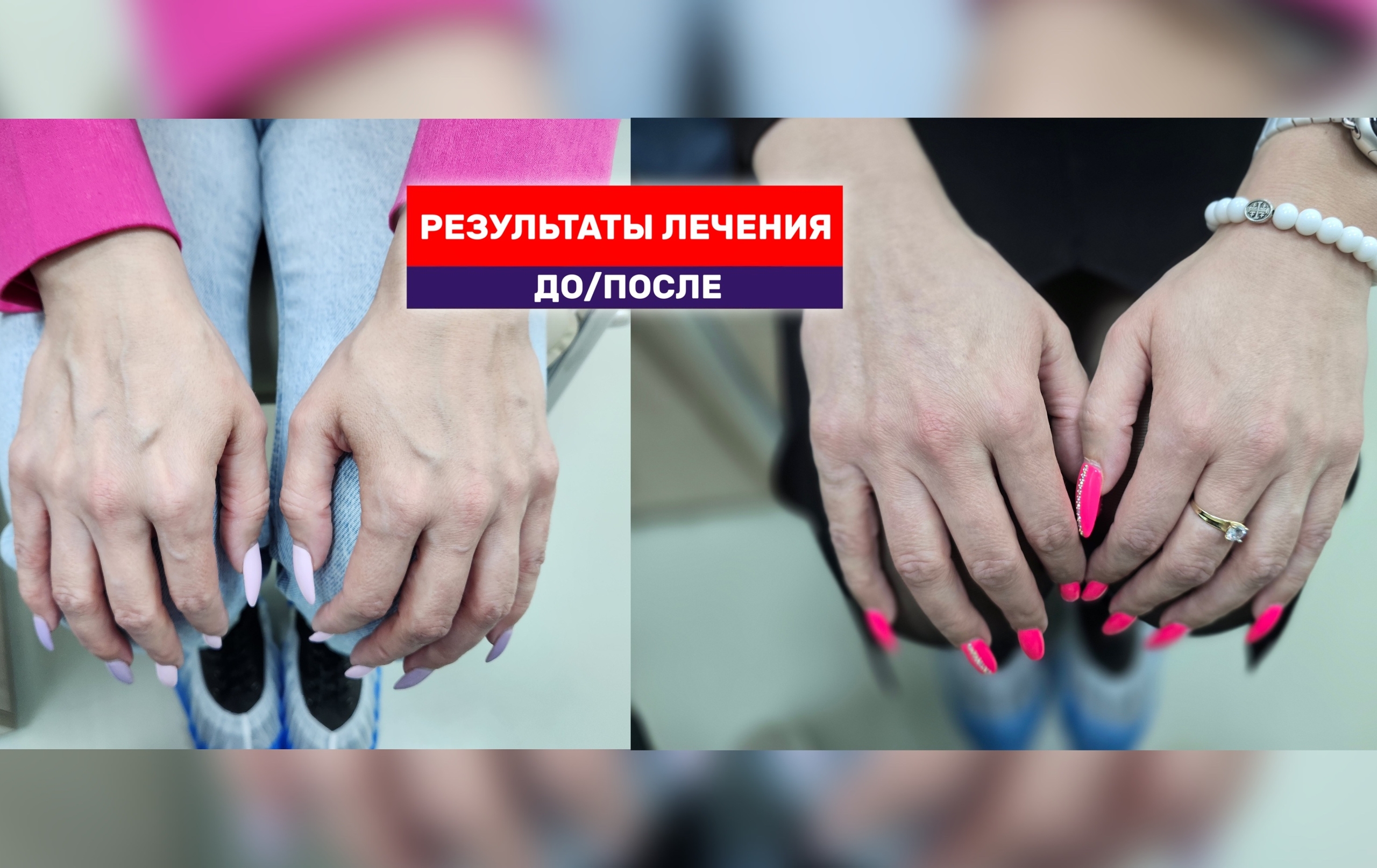 Красивые руки без выступающих вен - это реально и безопасно