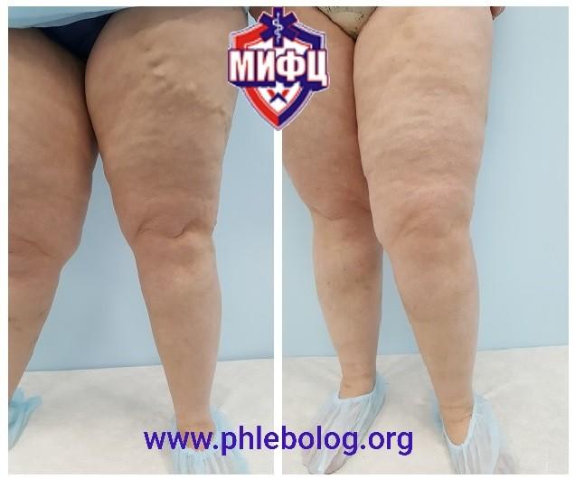 Лазерная коагуляция и минифлебэктомия по Варади