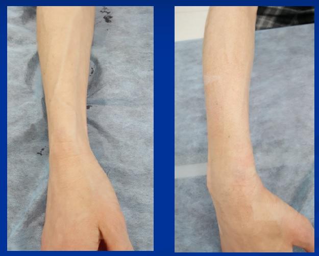 Вены правой руки до и после склерозирования (фото до и после)